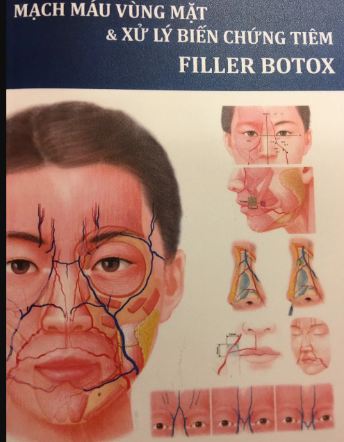 Mạch máu vùng mặt và xử lý biến chứng tiêm Filler B0t0x